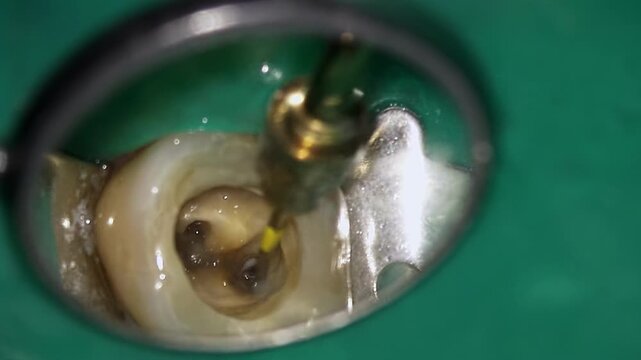Detailed view of tool near canal opening. Reflection of dental instrument at canal entrance observed clearly. Close inspection of dental tool reflecting at entrance of canal depicted precisely