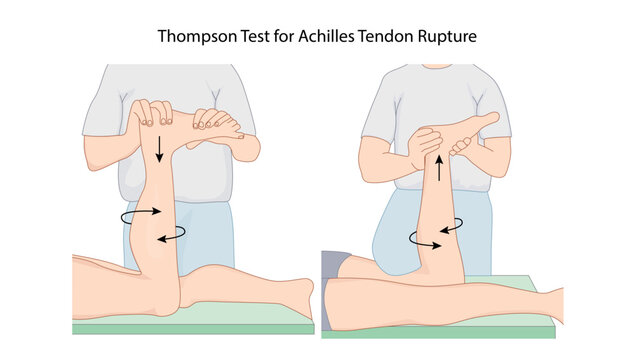 Thompson Test for Achilles Tendon Rupture
Clinical test demonstrating calf squeeze to assess integrity of the Achilles tendon based on plantarflexion response.