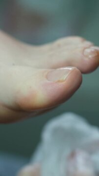 Close-up removal of calluses on the foot using a medical instrument. Treatment of diseases, defects, calluses on women's feet in a podiatry and pedicure salon. High quality 4k footage