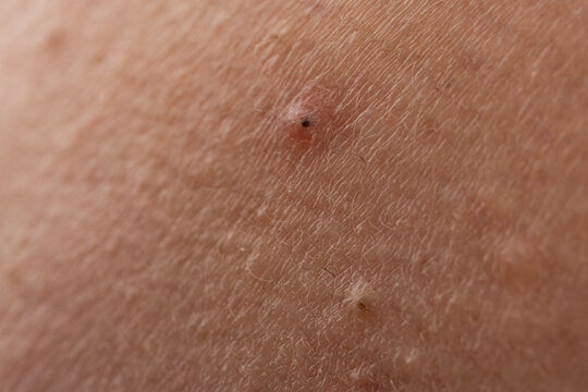 Acne on skin with comedone and sebum. Pimple with pustule and inflamed follicles. Dermatology skincare for pimple and acne. Macro texture of epidermis with irritation.