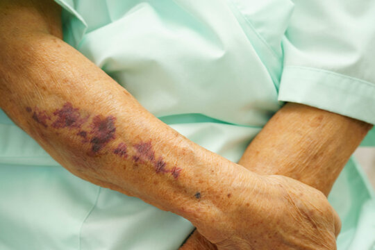 Ecchymosis, elderly bleeding on her arm after taking aspirin.
