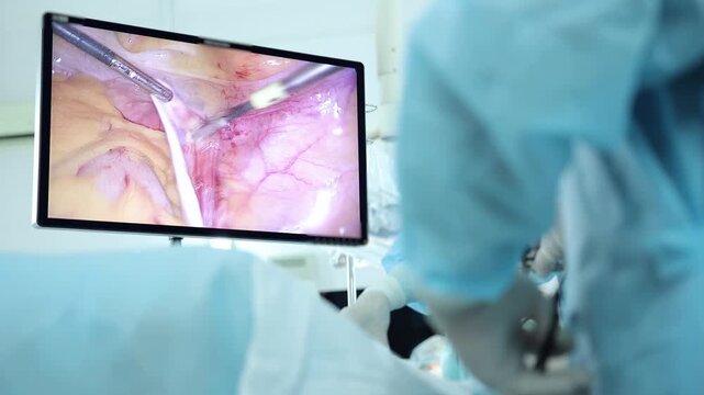 Laparoscopic camera for surgery to remove uterus and ovarian appendages in woman due to cancer.