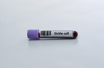 Fototapeta premium Blood sample tube for sickle cell test analysis.