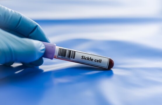 Blood sample tube for sickle cell test analysis.