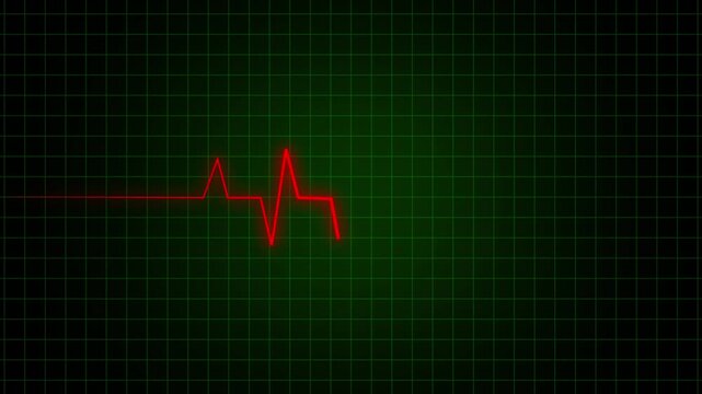 Medical graph depicting an electrocardiogram with a noticeable spike and decline pattern