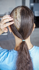 Naklejka premium Close up of surgical scar with staples on shaved head after craniotomy for brain tumor removal. Postoperative care, hygiene and recovery process concept.