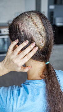 Close up of surgical scar with staples on head after craniotomy for brain tumor removal. Neurosurgery recovery and postoperative healing concept.