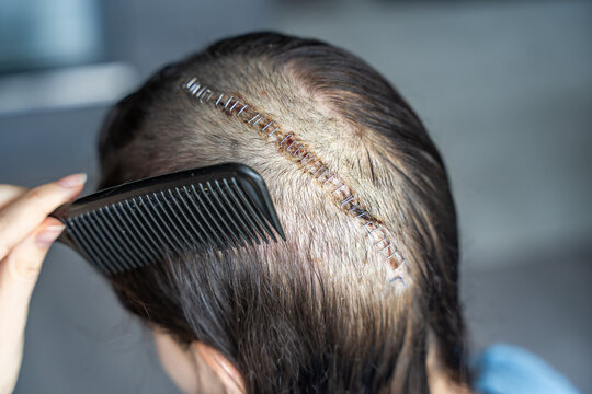 Woman carefully combing hair near surgical scar with staples after craniotomy for brain tumor removal. Postoperative care and recovery routine concept.
