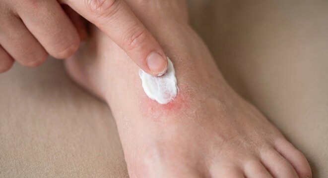 Applying medicinal ointment to irritated skin on foot