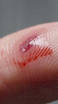 Vertical video. Man moistens a wound on his finger with hydrogen peroxide solution, killing harmful microbes and disinfecting it.