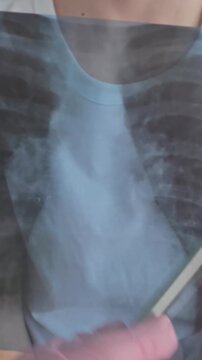 X-ray shows chest area with focus on lungs and heart during a medical examination in a clinic setting