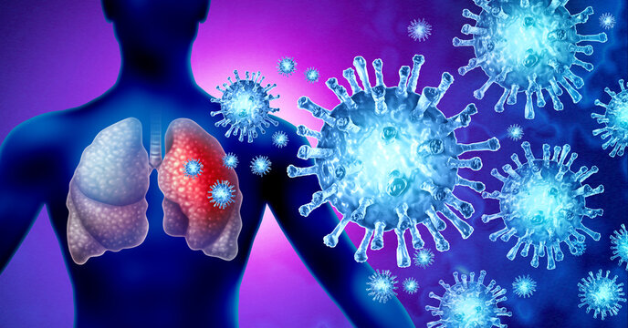 HMPV Respiratory Infection as an infectious Virus or Human metapneumovirus as a infected lungs in the Pneumoviridae family that infects the upper and lower airways resulting in cold like symptoms bron