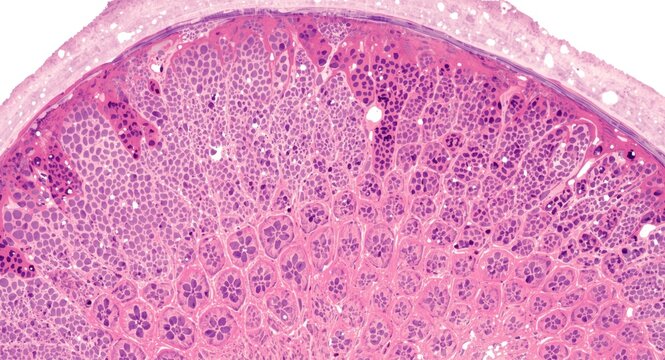 High resolution histological image of granulomatous mastitis affecting breast tissue