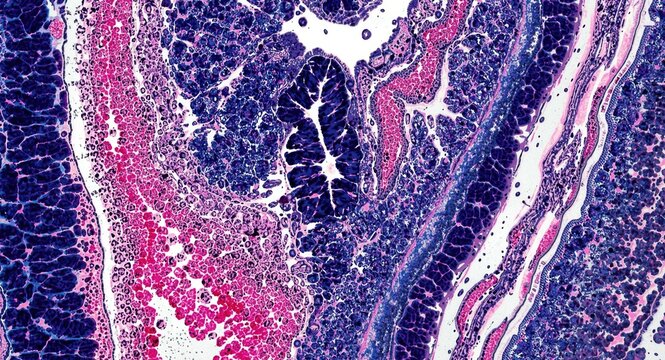 Lynch Syndrome Diagnostic Stains Displayed in Colon Cancer Tissue Sections