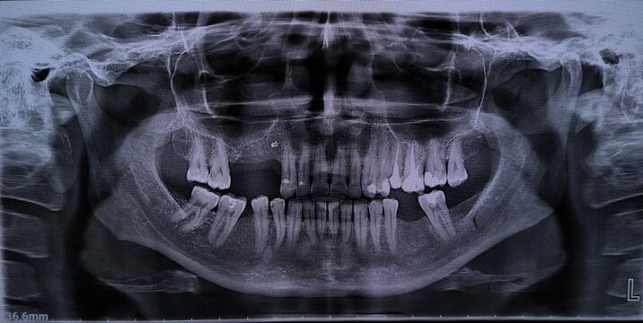 Panoramic X-ray of the jaw of a patient with bad teeth. Missing teeth. Destroyed teeth.