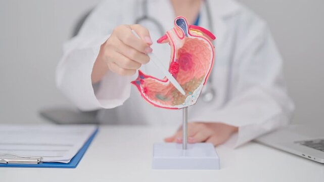 Doctor with Gastric anatomy model. Gastroenterologist consultation, stomach diseases and ulcers, November stomach cancer, Gastroesophageal Reflux Disease, GERD, Acid reflux and healthcare medical