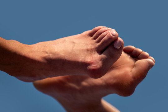 Hallux valgus deformity of big toe joint. Bare foot with Hallux valgus deformation. Human foot sole with deformities. Hallux Valgus on female legs close up. Feet of woman with hallux valgus.