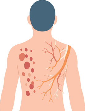 Illustration of a faceless back view of a person with clustered red rash spots following a highlighted nerve path, representing shingles viral infection and localized nerve pain