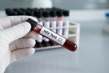 Obraz premium HIV blood test tube in hand, medical testing, diagnosis, virus detection, healthcare screening, laboratory analysis, ideal for medicine, prevention and disease awareness concepts