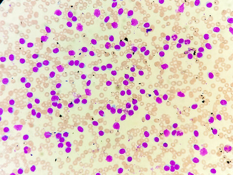 Acute Leukemia. Acute leukemia on microscopic examination. Leukemia in blood test. 