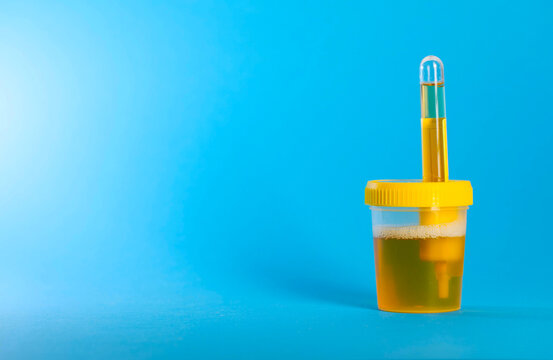 Pouring urine from a culture container into a transport tube against a blue background. Concept of urine testing for infections and bacteria, Citrobacter spp and Klebsiella spp. Copy space for text