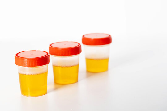 A three-glass urine sample on a white background. Urine analysis for leukocytes, turbidity, and mucus in kidney stones, close-up
