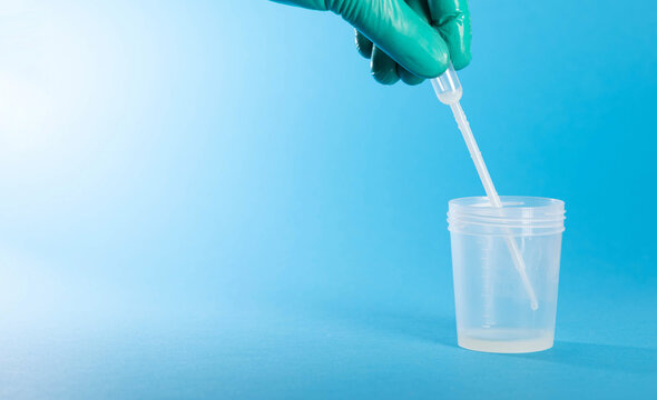 A laboratory technician collects prostate fluid in a test tube to test for flora and antibiotic sensitivity of infections. Leukocytes in prostate fluid, prostatitis. Copy space for text