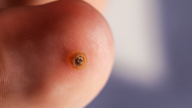 Verruca On Toe With Focused Lighting. A Macro Photograph Details The Skin Condition.