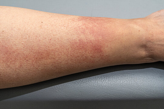 Elderly patient with vasculitis in the legs due to an adverse reaction to atenolol.