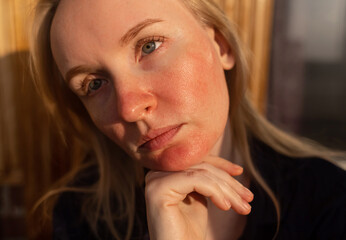 Fototapeta premium Rosacea and couperosis of the skin. The girl suffers from redness on her cheeks or sunburn symptoms. Redness and capillary mesh are visible on the face. Vascular surgery and dermatology