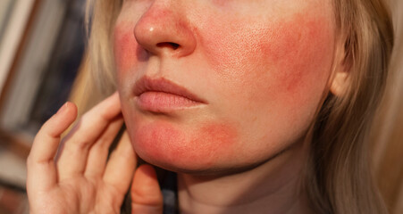 Rosacea and couperosis of the skin. The girl suffers from redness on her cheeks or sunburn symptoms. Redness and capillary mesh are visible on the face. Vascular surgery and dermatology © Siniehina