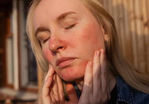 Rosacea and couperosis of the skin. The girl suffers from redness on her cheeks or sunburn symptoms. Redness and capillary mesh are visible on the face. Vascular surgery and dermatology