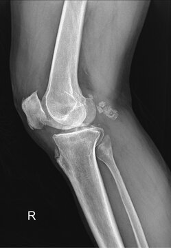 Right knee joint lateral X-ray showing degenerative changes and calcifications for medical education