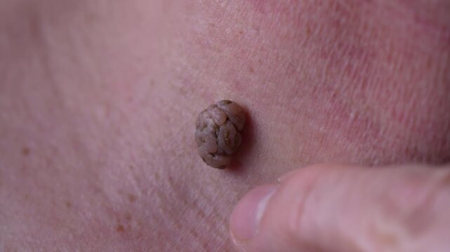 Macro close up of human skin with raised papilloma or mole showing texture and dermatology detail useful for medical education diagnosis and healthcare concept.