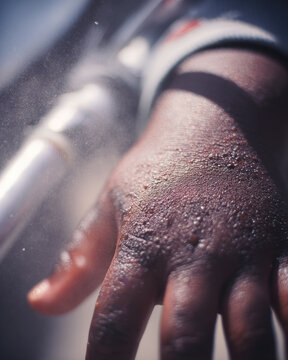 Hand skin close up moisture water spray dark skin texture child eczema dermatology close up of child hand with dark skin showing textured skin and moisture droplets from water spray highlighting