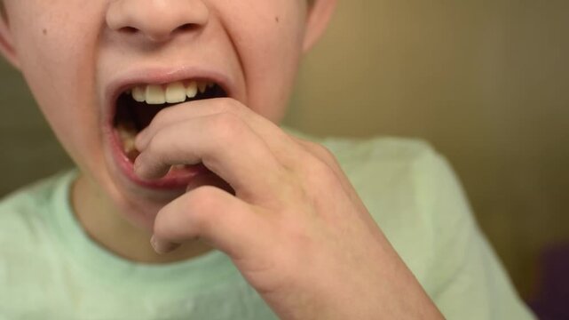 Boy wiggling loose milk tooth behind permanent tooth. Double row and dental overcrowding in child's mouth. Ectopic eruption concept.
