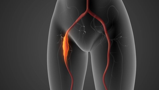 Peripheral arterial disease causing leg pain