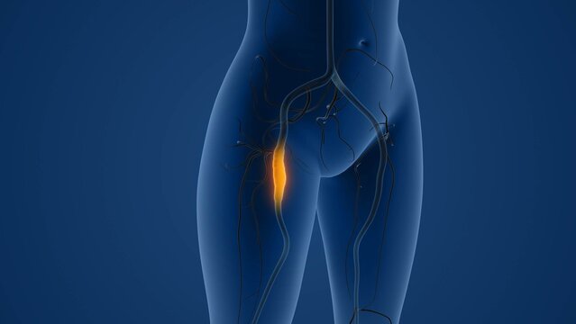 Claudication due to peripheral artery disease