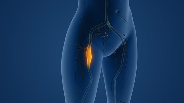 Claudication due to peripheral artery disease