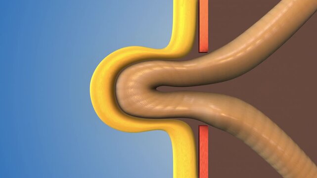 Hernia Bulge Forming in Abdomen Area