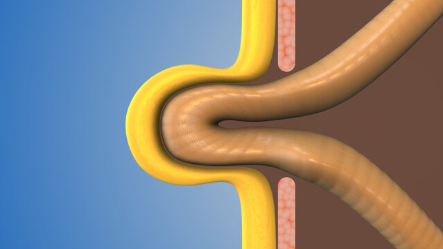 Hernia Bulge Forming in Abdomen Area