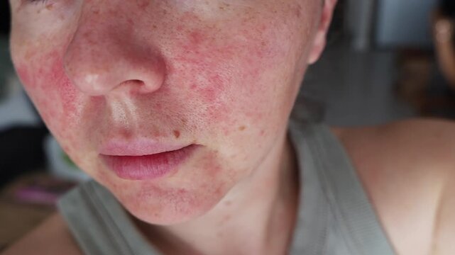 Woman no make up with red spots on her face. Health problem, skin diseases. Medicine and cosmetology concept. 
