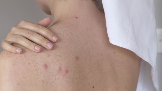 Woman touching sensitive back with acne and irritation. Sensitive skin reacts with redness and lesions, highlighting dermatology care and gentle skincare approach