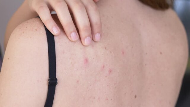 Close up of female back with visible acne and inflamed rashes. Rash condition includes red pustules and irritation presented in natural skin view within dermatology context and clinical observation