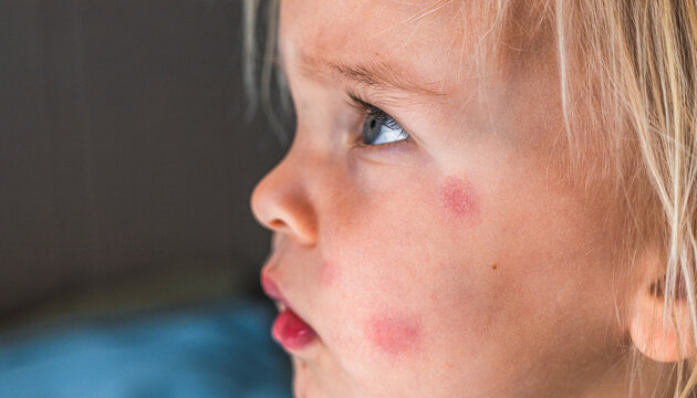 Redness on child's cheeks caused by eczema, dry skin or allergy