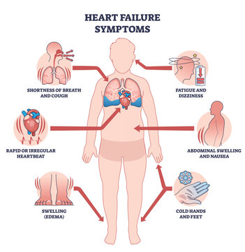 Heart failure symptoms overview shows a human silhouette with heart and lungs, arrows highlighting breathlessness, edema, and fatigue for quick patient education. Outline diagram