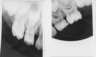 Black and white dental X-ray showing upper teeth and roots. Concept of dentistry, oral health, medical diagnostics, and dental care © leroy