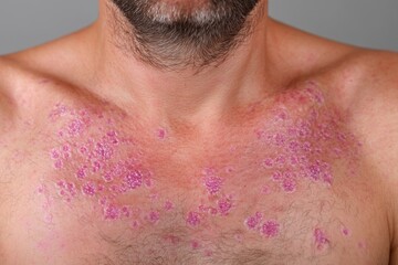 Fototapeta premium Close up of a man's chest and neck showing skin affected by a severe rash