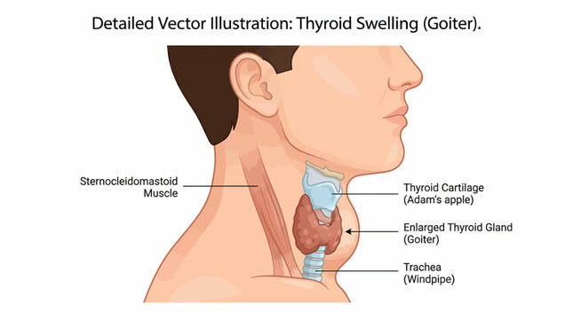 Detailed illustration of thyroid swelling condition known as goiter in human neck