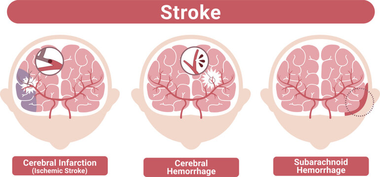 Stroke types brain infarction cerebral hemorrhage subarachnoid hemorrhage medical illustration(English Labels)